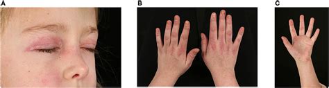 Frontiers The Vasculopathy Of Juvenile Dermatomyositis