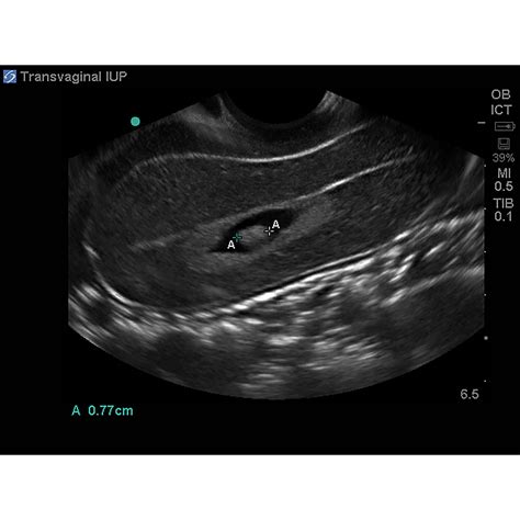 Cae Blue Phantom Ectopic Pregnancy Transvaginal Hot Sex Picture