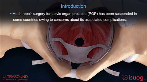 New Uogjournal Video Abstract On The Role Of Mesh Surgery In