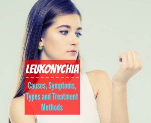 Leukonychia - Causes, Symptoms, Types and Treatment Methods - The ...