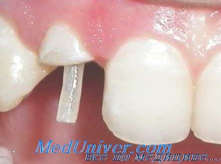 Типы коронок. Оценка зубов под коронки