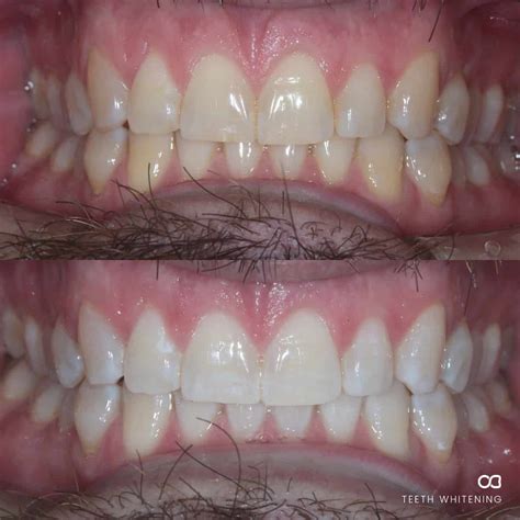 Teeth Whitening On The Gold Coast Oasis Dental Studio