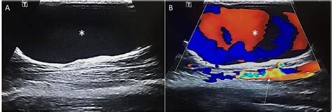 Grayscale A And Color Doppler B Ultrasound Of The Basilic Vein