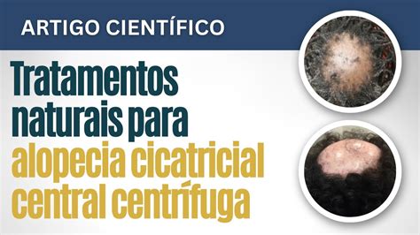 Alopecia cicatricial central centrífuga e propostas de tratamentos