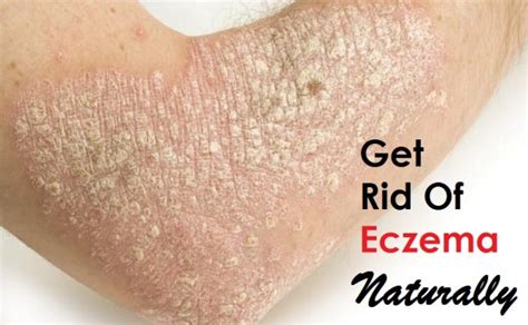 How to Get Rid of Eczema?