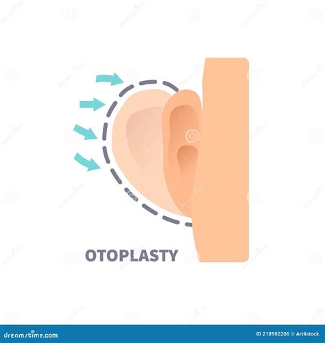 Otoplasty Procedure Line Outline Icon Cartoon Vector Cartoondealer