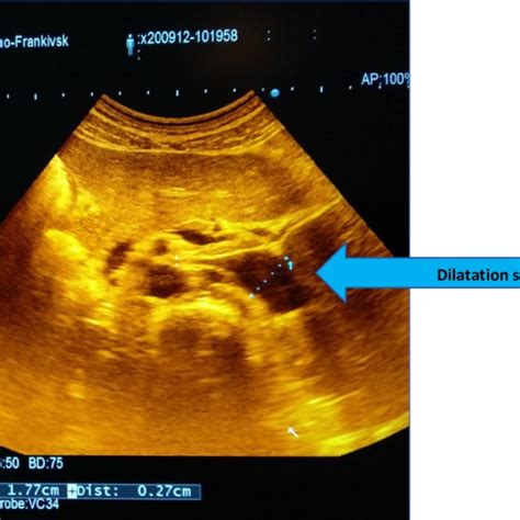 Ultrasound Pattern Of The Nutcracker Syndrome B Mode Download Scientific Diagram