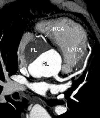 A Year Old Man With A Type Aortic Dissection In An Axial Mip