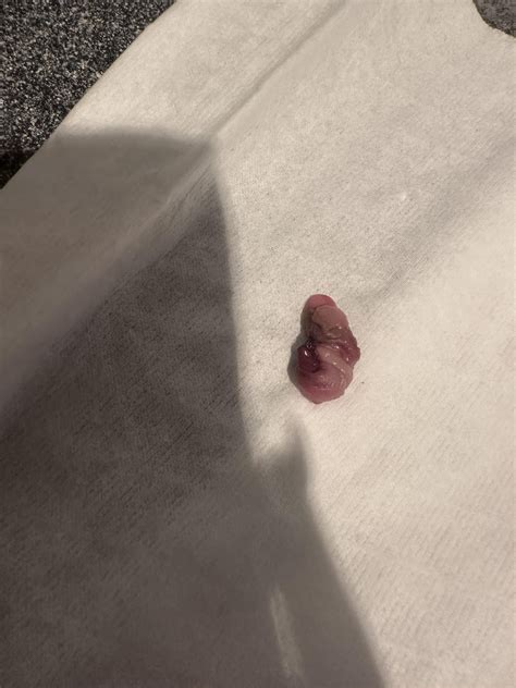 BLOOD CLOT, MISCARRIAGE, OR DECIDUAL CAST?? : r/Periods