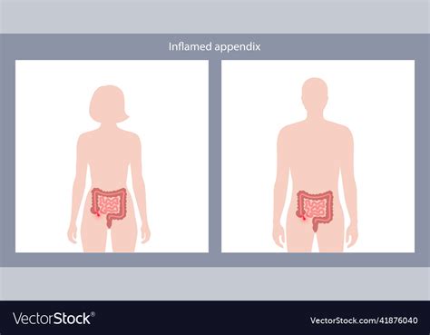 Appendix Pain Concept Royalty Free Vector Image