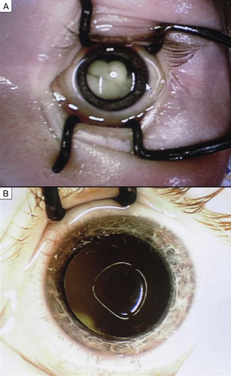 Figure 1 From Superselective Intra Arterial Chemotherapy For Advanced