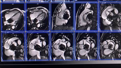 Cardiac Mri Axial Shax Left Atrium Myxoma Part Youtube