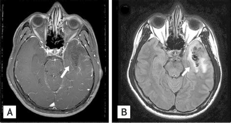 T1 Weighted Image A And T2 Flair Image B Of Brain Magnetic Download Scientific Diagram