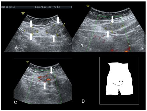 Endometriosis Ultrasound