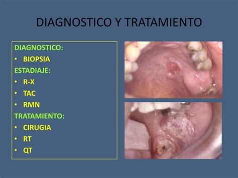 Tumores Benignos Y Malignos De Cavidad Oral Ppt