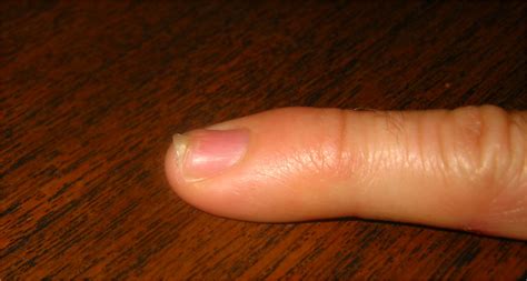 Soul Amp: Recovery of Smashed Fingernail after 5.5 months... Photos of ...