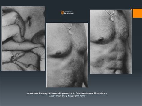 Lipoescultura De Alta Definici N Marcaci N Adbominal Ppt