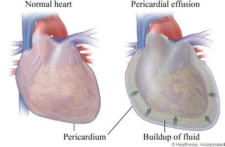 Pericardiectomy