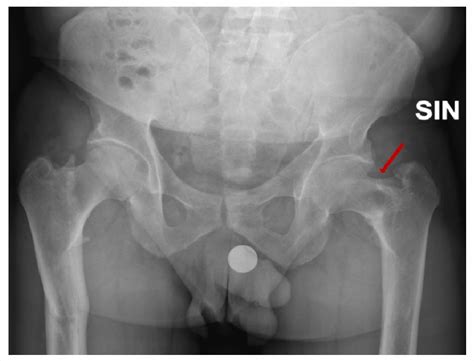 First X Ray Of The Patient The Femoral Neck Stress Fracture Is