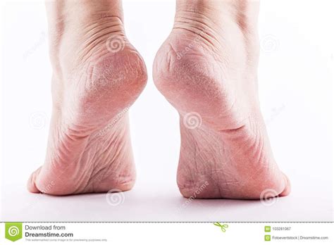 Dry Heels Woman On A White Background Closeup Stock Image Image Of