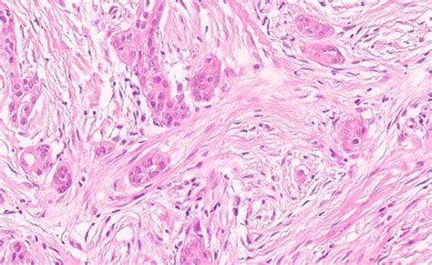 Hematoxylin And Eosin Stained Section Of A Low Grade Adenosquamous