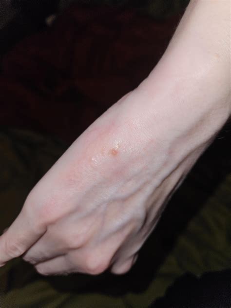 Potential Allergic Contact Dermatitis Type Reaction To A Hydrocolloid Bandage R Diagnoseme