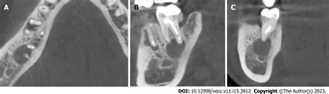 Application Of Apical Negative Pressure Irrigation In The Nonsurgical