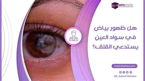 ذبابة العين الطائرة الأسباب وطرق العلاج دكتور اشرف سليمان