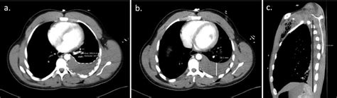 Ct Based Pleural Effusion Volume Estimation Formula Demonstrates Low Accuracy And