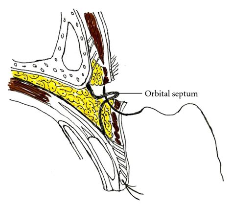 Tucking of the orbital septum. | Download Scientific Diagram