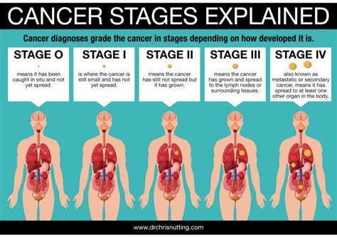 Dr Chris Nutting Cancer Stages Explained