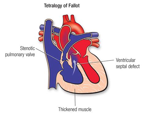 Blog Tetralogy Of Fallot Ultrasound Scan Center Malaysia