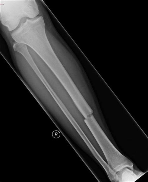 Overview Of Fractures Injuries And Poisoning Merck Manual Consumer