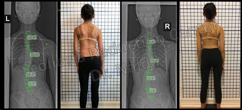 Scoliosis Treatment Results - See Before and After Pictures