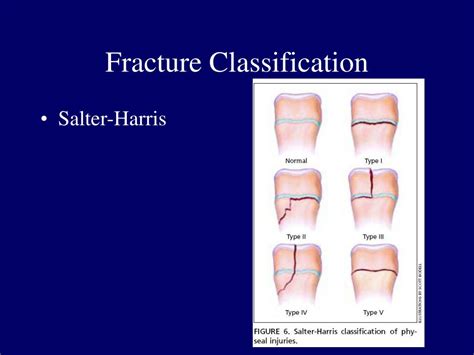 Ppt Foot Stress Fractures Powerpoint Presentation Free Download Id 6797086