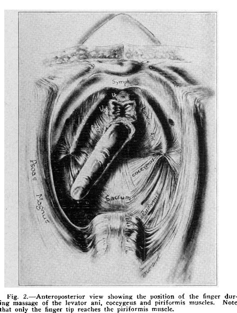 coccydynia | Semantic Scholar