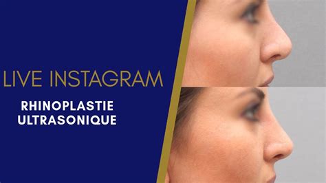 Live Instagram Les Nouvelles Techniques De Rhinoplastie Youtube