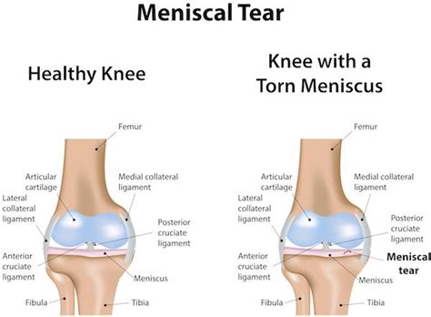 Exercises You Can Do With A Torn Meniscus Online Degrees