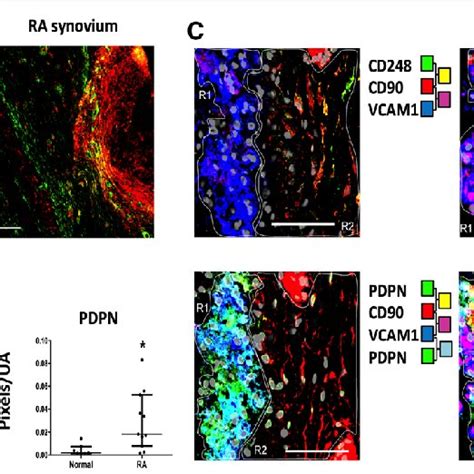 Expression Of CD248 And Podoplanin PDPN In Cultured RASF Three