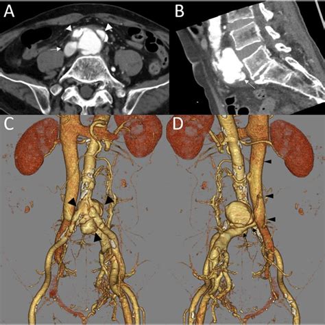 Preoperative Computed Tomography Ct Findings A Axial View Of The