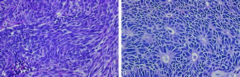 Unusual Features Observed In Sinonasal Basaloid Squamous Cell Carcinoma