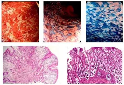 六种肠道消化溃疡性疾病的内镜鉴别诊断