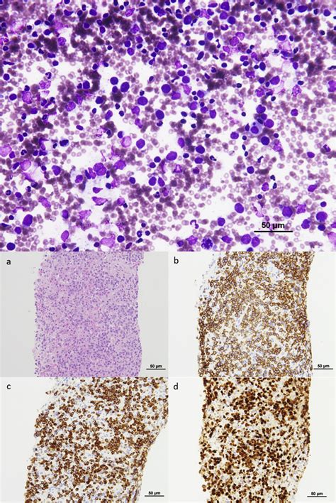 Representative Touch Smear Cytology Of Rapid Onsite Evaluation ROSE