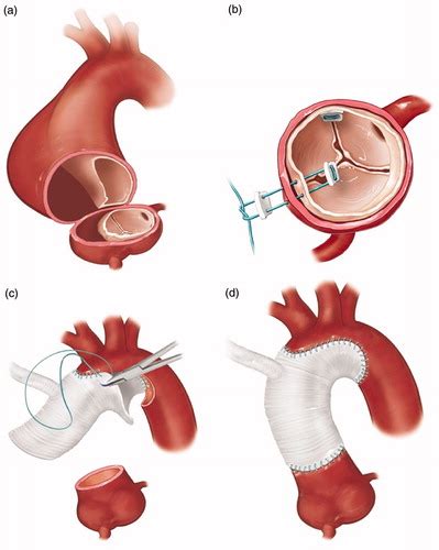 Full Article Acute Type A Aortic Dissection A Review