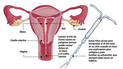 O Melhor M Todo Contraceptivo O Diu S Dra Greice Chetta