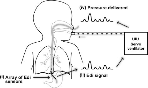 Neurally Adjusted Ventilatory Assist In Newborns Clinics In Perinatology