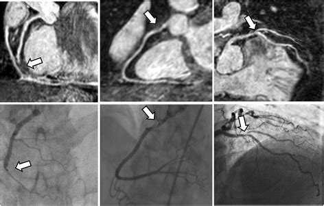 Diagnostic Performance Of Image Navigated Coronary Cmr Angiography In