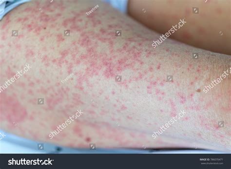 2,438 Drug Rash Images, Stock Photos & Vectors | Shutterstock