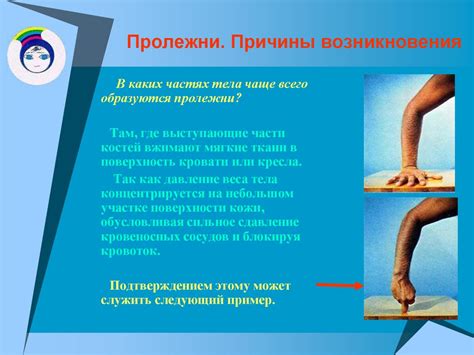 Профилактика пролежней - презентация онлайн