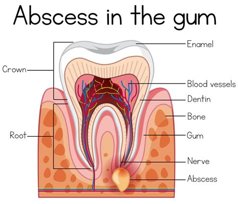 Dental Abscess Know The Symptom Cause And Treatment